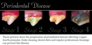 4 Stages of Periodontal Disease